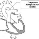 congenital heart defects are patent ductus arteriosus