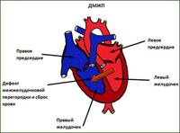 Vrozené srdeční vady: vady ductus arteriosus, defekty síňového a komorového septa