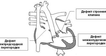 congenital heart disease pulmonary stenosis, atrioventricular canal