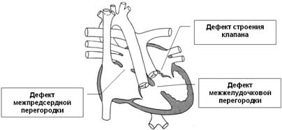 Doença cardíaca congênita: canal atrioventricular, estenose pulmonar