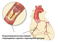 Prevention of ischemic heart disease
