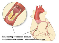 Профилактика на коронарна болест на сърцето