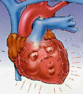 Arrhythmia of the heart