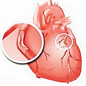 Cinco mitos sobre el ataque al corazón