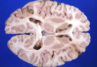 Енцефалопатия на мозъка