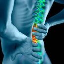 you need to know about spinal arachnoiditis