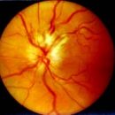 neuritis and vision