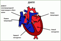 Įgimtos širdies defektai: atviras arterinis ortakis, intersdest ir interescular skaidinio defektai