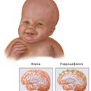 diagnosis of hydrocephalus in children