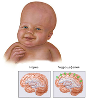 Diagnose af hydrocephalius hos børn
