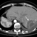 hemangioma of the liver