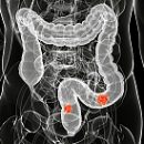 bowel cancer symptoms and risk factors