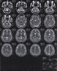 MRI mozku
