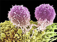 a new type of tumor marker in the diagnosis of ovarian cancer