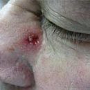 basal cell skin cancer and basal cell carcinoma