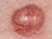 Jak vypadá rakovina kůže bazálních buněk?