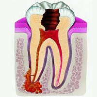 嚢胞の歯