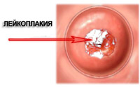 Symptome und Behandlung von zervikaler Leukoplakie