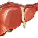 methods of diagnosis and treatment of liver cancer