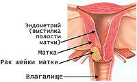 cervical cancer 3