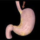 stomach cancer diagnosis of gastric cancer