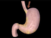 stomach cancer diagnosis of gastric cancer