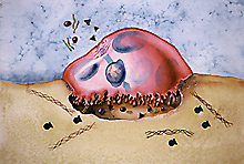 Osteosarcoma