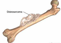 Maligne knogler og brusk tumorer