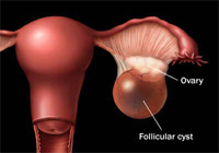 Manifestações do câncer de ovário