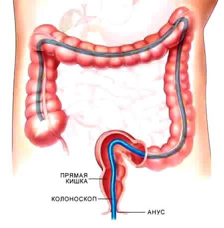 Værktøjsdiagnostiske metoder til intestinal cancer