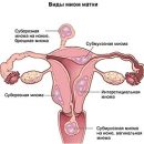 treatment of uterine fibroids what's new