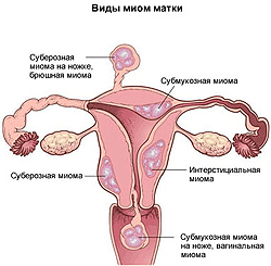 Trattamento di myoma utero. Cosa c'è di nuovo?