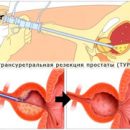transurethral removal of the prostate area