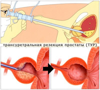 Трансуретрално отстраняване на част от простатата