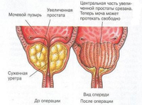 postoperative period after resection of the prostate