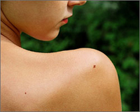 Skin melanoma than moles are dangerous