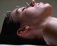 Acupunctura: secrete de traditionale