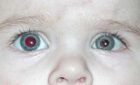 cytomegalovirus infection in children