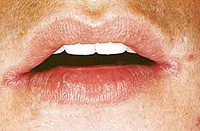 candidiasis of the oral mucosa
