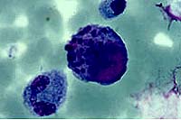 Cytomegalovirus: fatální polibek