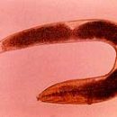 Enterobiasis or pinworm infection