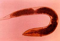 Enterobiasis or pinworm infection