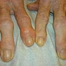 treatment of osteoarthritis of the joints of the fingers