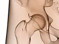 Artrosi del giunto dell'anca: sintomi e tappe