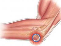 Il trattamento tempestivo dell'artrosi del gomito consentirà di mantenere l'articolazione