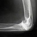 how to treat osteoarthritis of the elbow joint