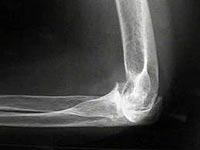 How to treat osteoarthritis of the elbow joint?