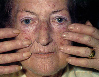 systemic scleroderma
