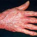 What is systemic scleroderma