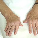 treatment of rheumatoid arthritis